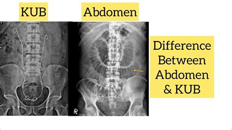 kub abbreviation medical|Abdomen (KUB view) .